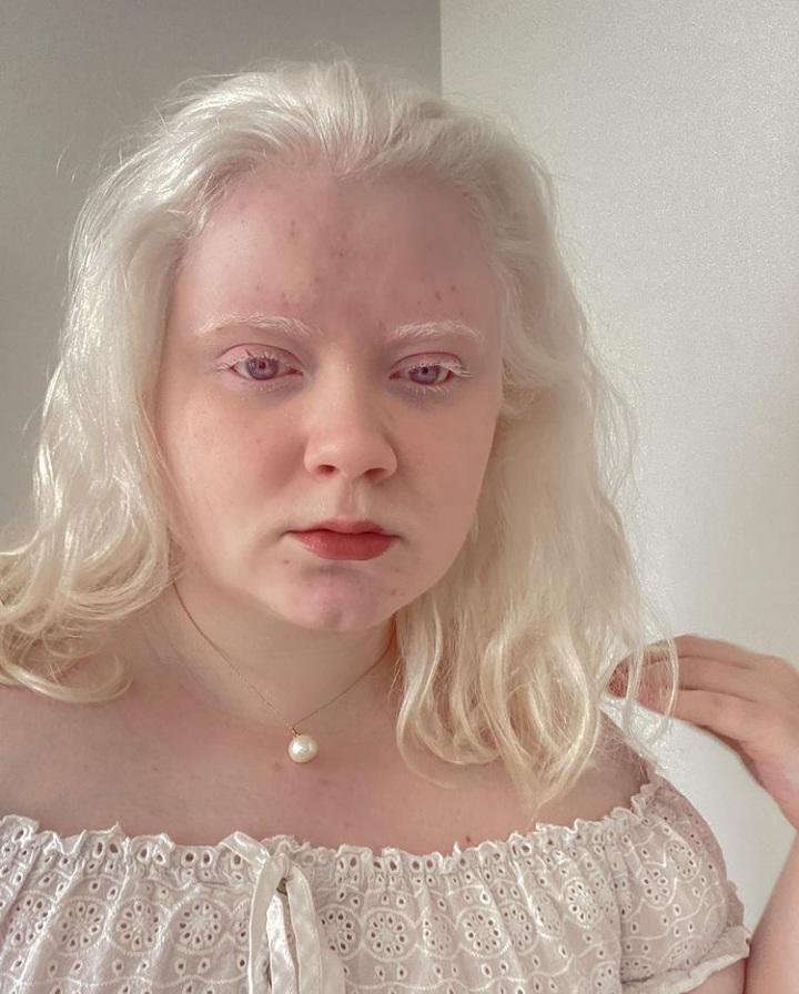 white albino