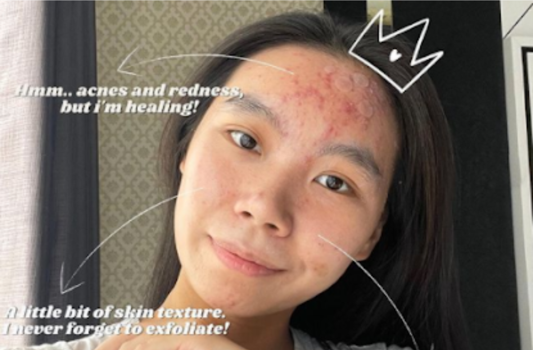 Ferend: Acne Skin = Normal Skin