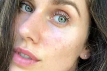 Cassandra's Modeling Journey with Acne: The Beauty of Facing Yourself without Flawless Skin